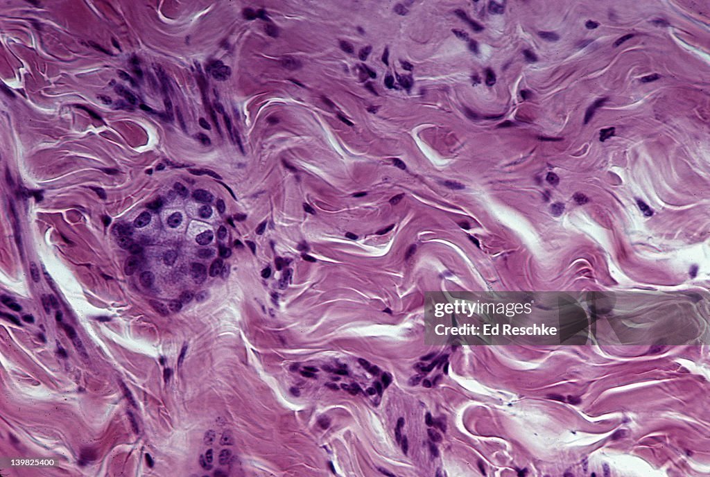 DENSE FIBROUS CONNECTIVE TISSUE (IRREGULAR); SHOWS IRREGULAR COLLAGENOUS FIBERS (PINK) AND FIBROBLAST NUCLEI (PURPLE); FROM THE DERMIS OF THE SKIN