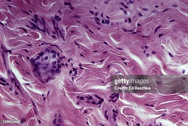 dense fibrous connective tissue (irregular); shows irregular collagenous fibers (pink) and fibroblast nuclei (purple); from the dermis of the skin - menschliche zelle stock-fotos und bilder