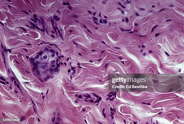 dense fibrous connective tissue (irregular); shows irregular collagenous fibers (pink) and fibroblast nuclei (purple); from the dermis of the skin - microphotographie immunofluorescente photos et images de collection