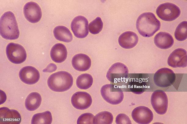 pernicious anemia, 400x abnormal & variable red blood cells, many macrocytic & abnormally fragile. h vitamin b12 deficiency - anemia fotografías e imágenes de stock