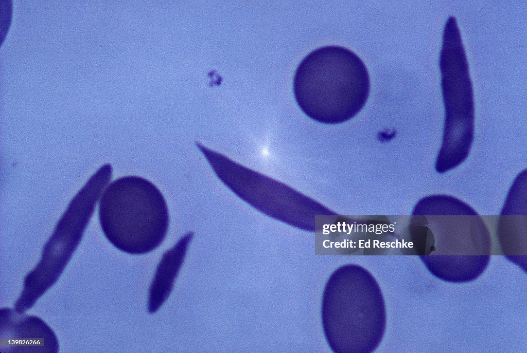SICKLE CELL ANEMIA. NORMAL AND SICKLED RED BLOOD CELLS. 640X H