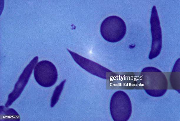 sickle cell anemia. normal and sickled red blood cells. 640x h - sickle cell stock pictures, royalty-free photos & images