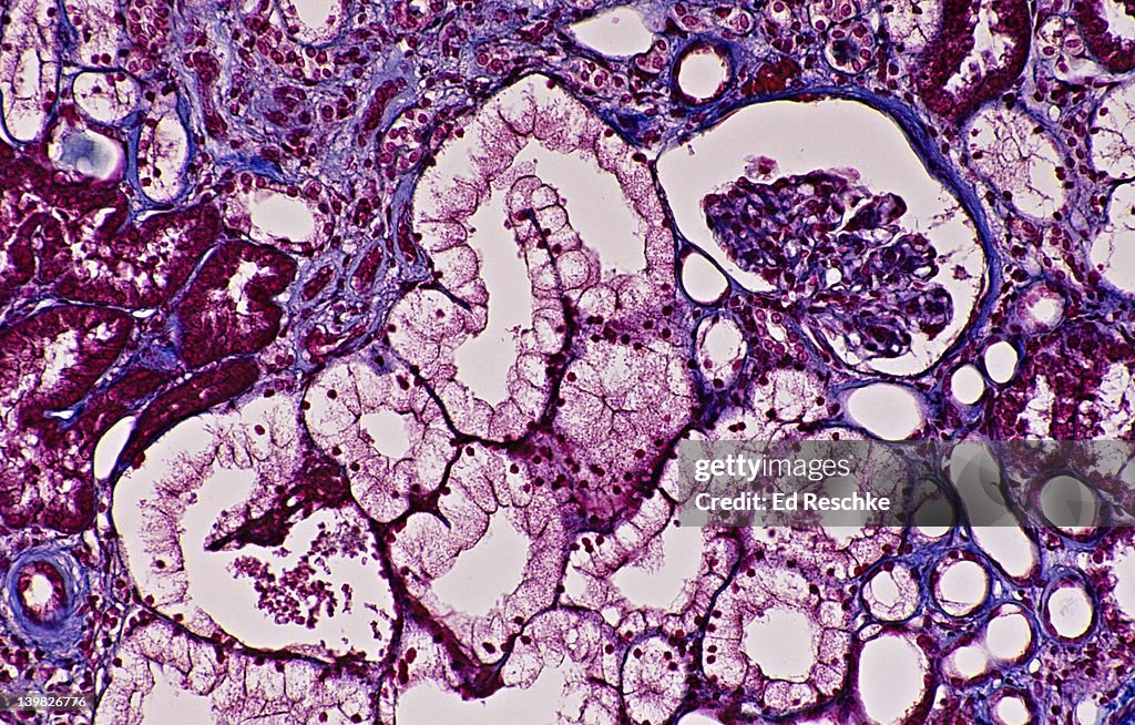 KIDNEY --- NEPHRON, GLOMERULUS, BOWMAN S CAPSULE, KIDNEY TUBULES, 50X. Human. Shows: glomerulus, Bowman s capsule, renal tubules (proximal, distal & loop of Henle) Mallory stain.