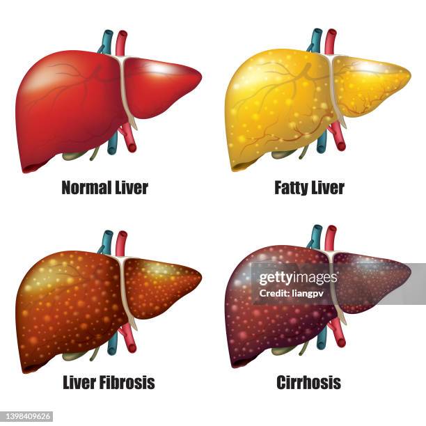 bildbanksillustrationer, clip art samt tecknat material och ikoner med stages of liver disease - cirrhosis