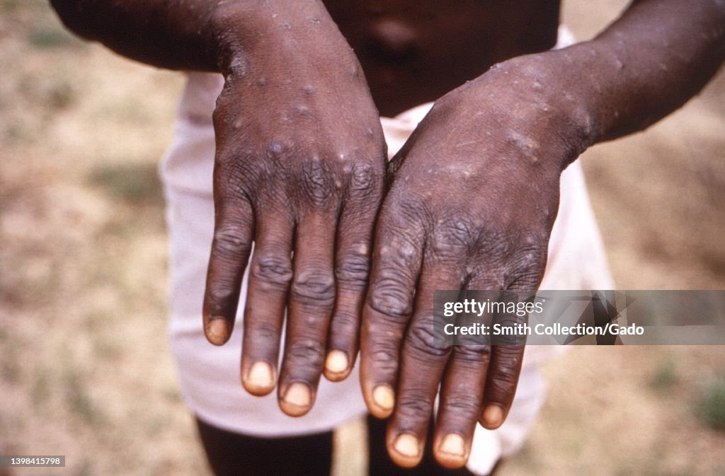 Monkeypox Lesions