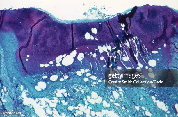 Under a microscope magnification of 50X, this image depicted a section of skin tissue, harvested from a lesion on the skin of a monkey, that had been...