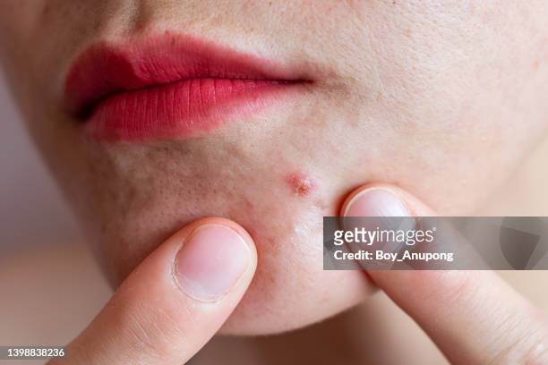 cropped shot of woman pointing to acne occur on her lower face. - haka bildbanksfoton och bilder