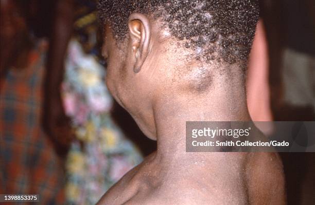 Swellings diagnosed as lymphadenopathy or lymph node enlargements on the neck of a patient infected with the monkeypox virus, the Democratic Republic...