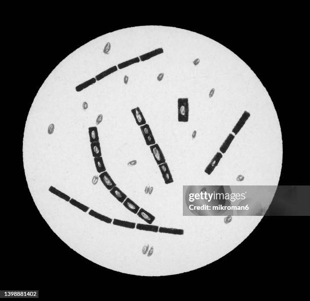 old chromolithograph illustration of magnification of bacteria bacillus anthracis - cutaneous anthrax photos et images de collection