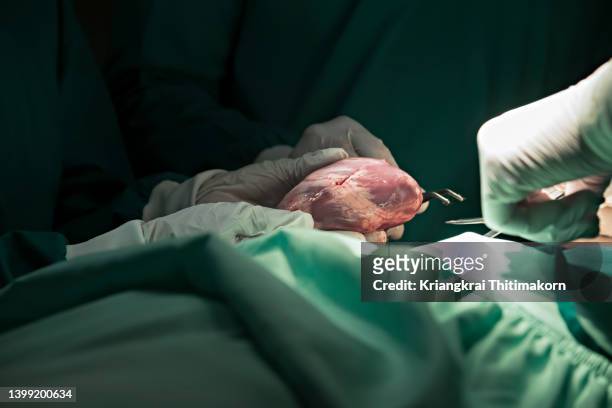 surgeons are performing heart transplant operation for a patient. - transplant surgery bildbanksfoton och bilder