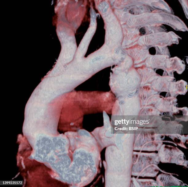 coarctation of the aorta - aorta fotografías e imágenes de stock