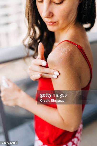 close up of woman applying moisturizer on sunburned skin - skin rash stock pictures, royalty-free photos & images