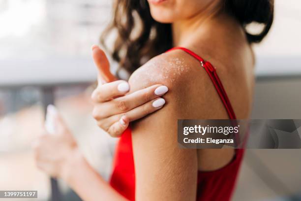 primer plano de la mujer que aplica crema hidratante en la piel quemada por el sol - piel humana fotografías e imágenes de stock