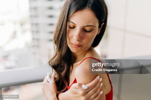 femelles brûlées par le soleil - coup de soleil photos et images de collection