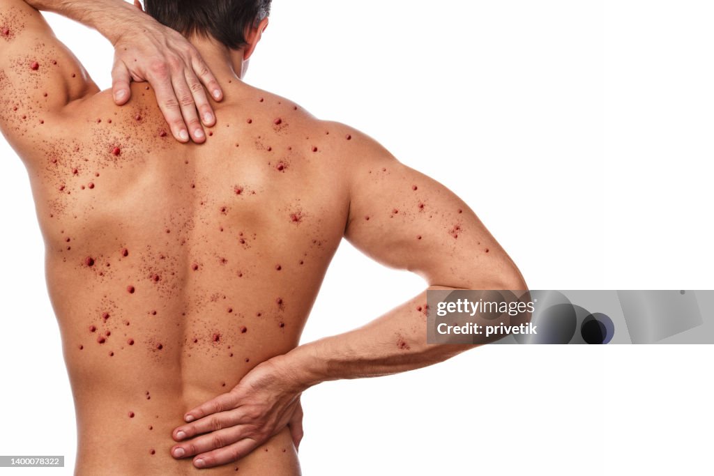 Back Rash Infection Male Back Affected By Blistering Rash Because Of Monkeypox Or Other ...