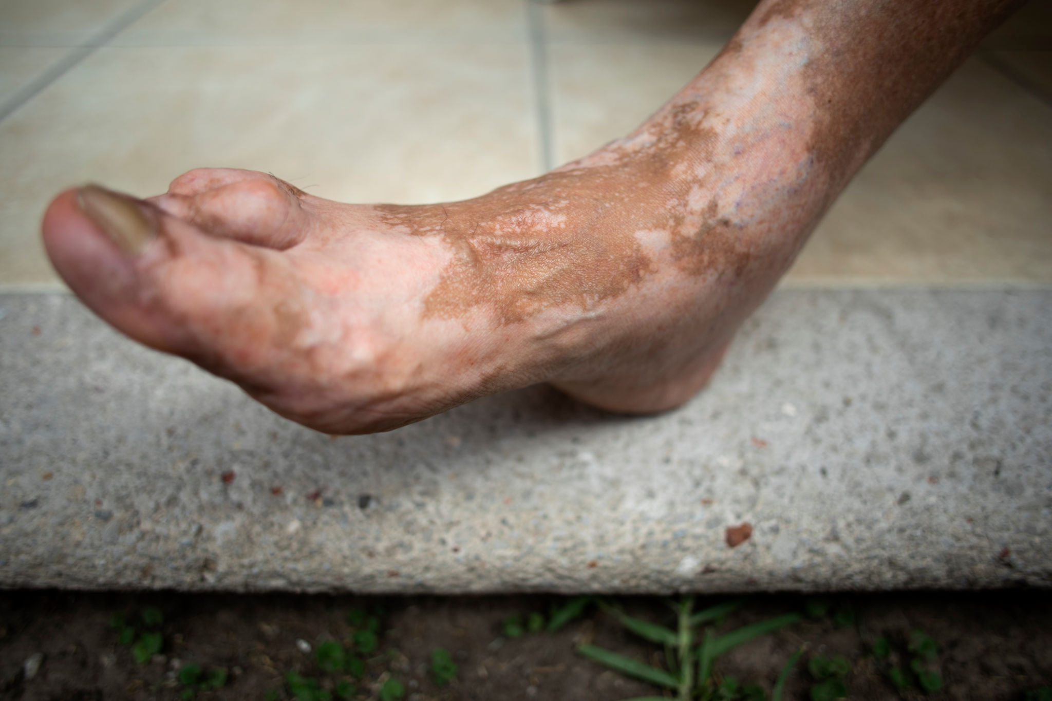 guttate psoriasis skin