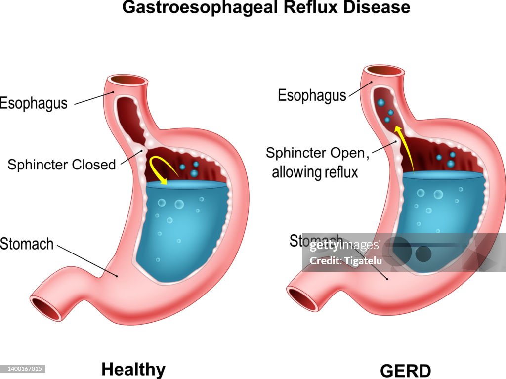 Gerdft Gastroesophageal Reflux Disease High-Res Vector Graphic - Getty Images
