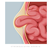 Strangulated Hernia -  Section of the Small Intestines - Stock Illustration