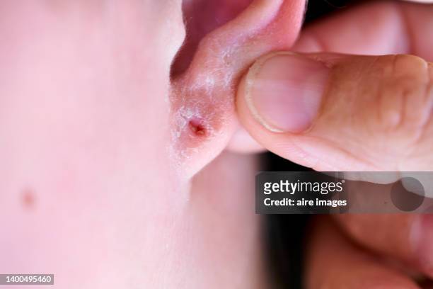 close up view of doctor human hand holding and examining infected ear to patient - ear close up women stock-fotos und bilder