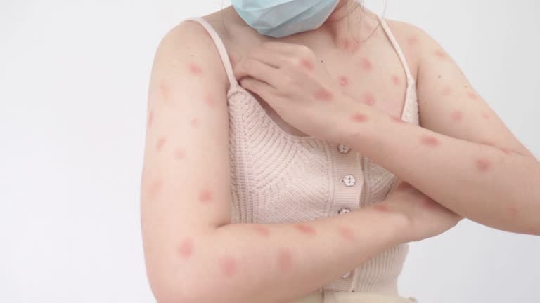 Monkeypox Rash Pustules 12 Smallpox Pustules Stock Videos, Footage, & 4K Video Clips - Getty Images