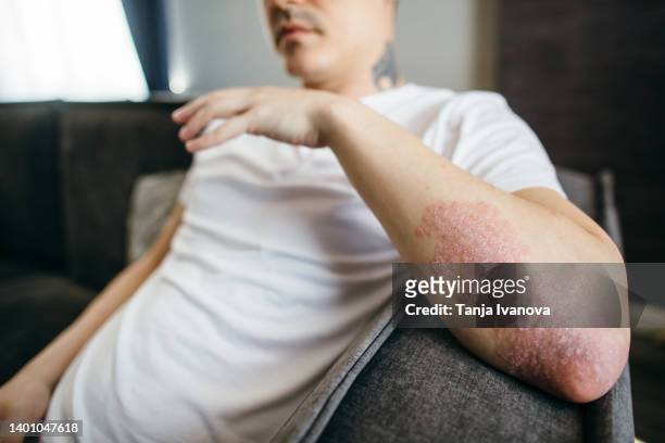 close-up of the peeling skin of a man on his hands with eczema, psoriasis and other skin diseases such as fungus, plaque, rash and spots. autoimmune genetic disease. - skin fungus stock pictures, royalty-free photos & images
