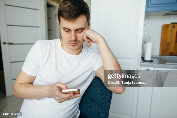 young man with psoriasis on his hands uses a phone while sitting in the kitchen at home - psoriasis stock pictures, royalty-free photos & images