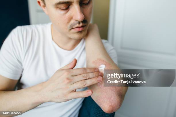 man who uses ointments, creams in the treatment of eczema, psoriasis and other skin diseases such as fungus, plaque, rash and spots. autoimmune genetic disease. - psoriasis fotografías e imágenes de stock