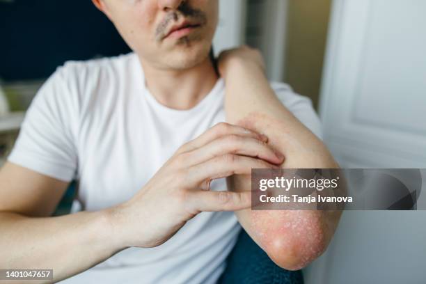 man scratches the flaky skin on his hands with eczema, psoriasis and other skin diseases such as fungus, plaque, rash and spots. autoimmune genetic disease. - touching elbows stock pictures, royalty-free photos & images