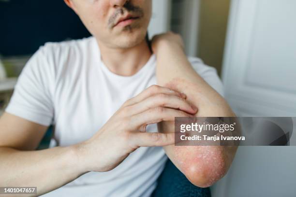 man scratches the flaky skin on his hands with eczema, psoriasis and other skin diseases such as fungus, plaque, rash and spots. autoimmune genetic disease. - han river bildbanksfoton och bilder