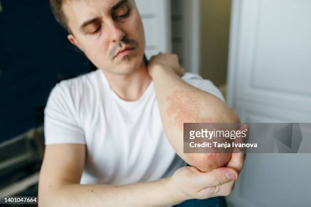 man looks at the flaky skin on his hands with eczema, psoriasis and other skin diseases such as fungus, plaque, rash and spots. autoimmune genetic disease. - psoriasis stock pictures, royalty-free photos & images