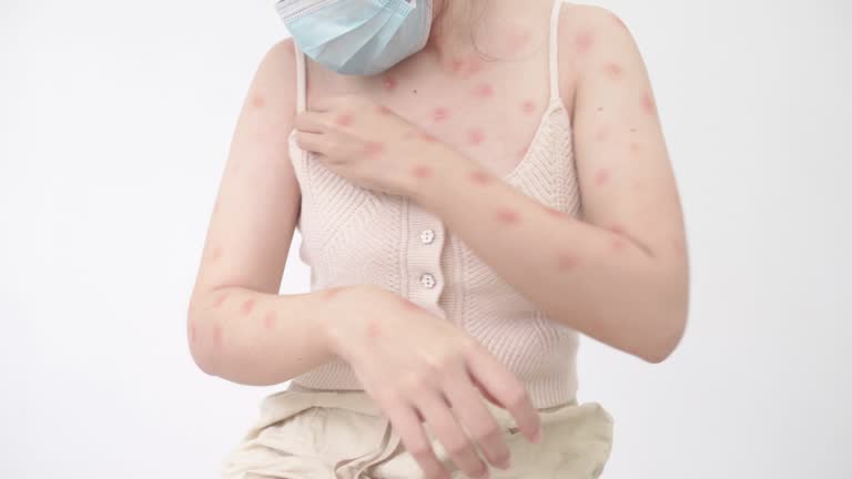 Monkeypox Rash Pustules 12 Smallpox Pustules Stock Videos, Footage, & 4K Video Clips - Getty Images
