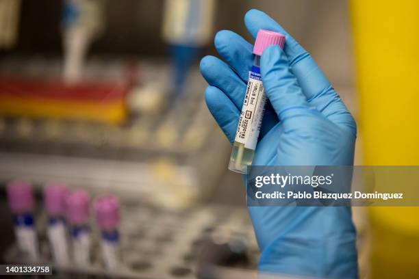 Medical laboratory technician shows a suspected monkeypox sample at the microbiology laboratory of La Paz Hospital on June 06, 2022 in Madrid, Spain....