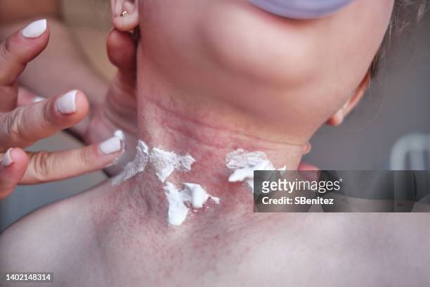 creams in the treatment of eczema and seborrheic dermatitis - eczema child stock-fotos und bilder