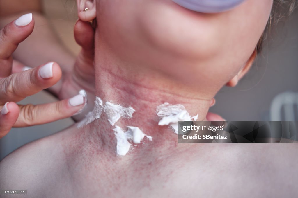 Creams in the treatment of eczema and seborrheic dermatitis