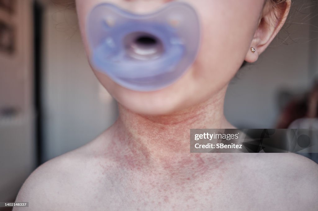 Many red pimples caused by atopic dermatitis