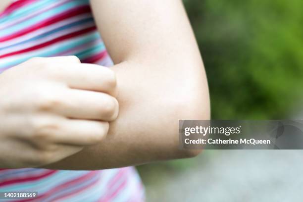 young mixed-race female scratches arm after insect bite - spotted fever stock pictures, royalty-free photos & images