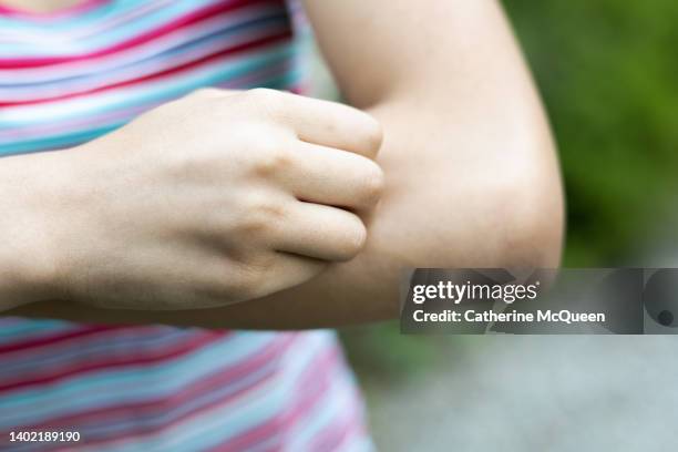 young mixed-race female scratches arm after insect bite - artrópodo fotografías e imágenes de stock