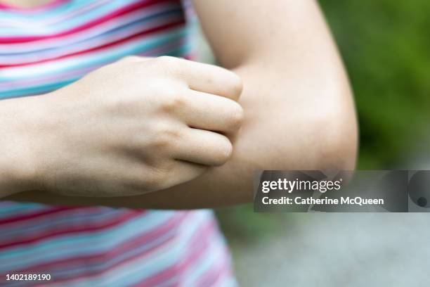young mixed-race female scratches arm after insect bite - west nile virus ストックフォトと画像