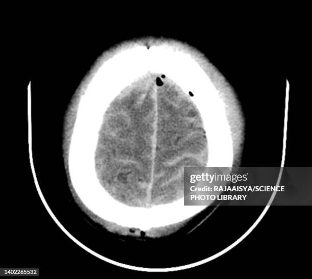 traumatic brain injuries, ct scan - concussion imagens e fotografias de stock