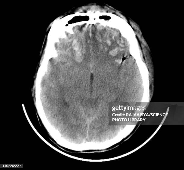 179 Traumatic Brain Injuries & Concussion Stock Photos, High-Res ...