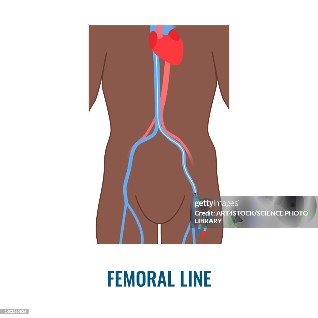 Femoral central venous catheter, illustration