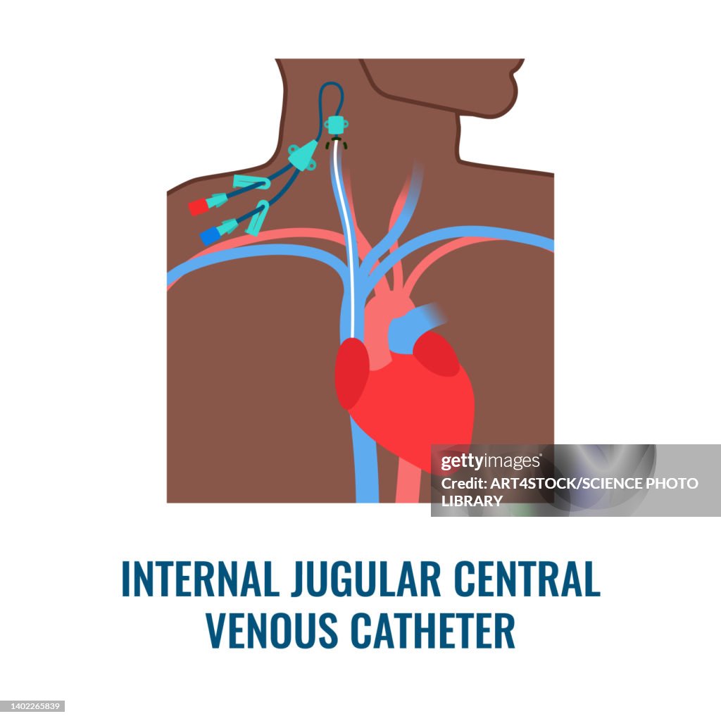 Central Venous Catheter Illustration High-Res Vector Graphic - Getty Images