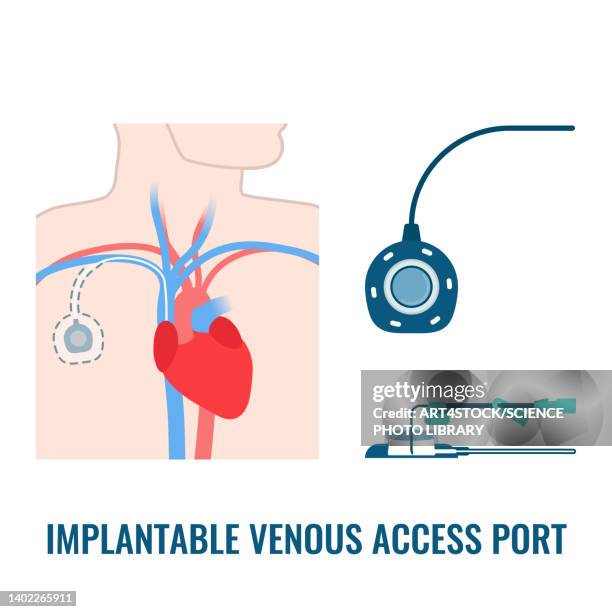 venous access port, illustration - chemo infusion stock illustrations