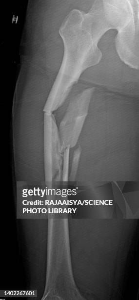 comminuted femur fracture, x-ray - femur stock-fotos und bilder