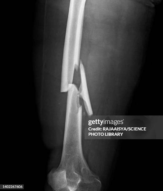 comminuted femur fracture, x-ray - knochenbruch stock-fotos und bilder