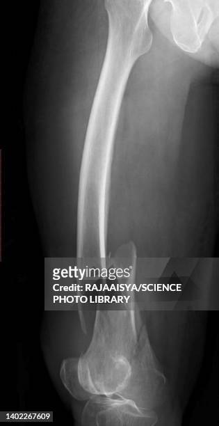comminuted femur fracture, x-ray - comminuted fracture stock pictures, royalty-free photos & images