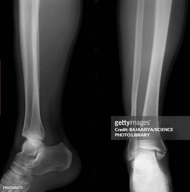 broken ankle, x-ray - fibula foto e immagini stock