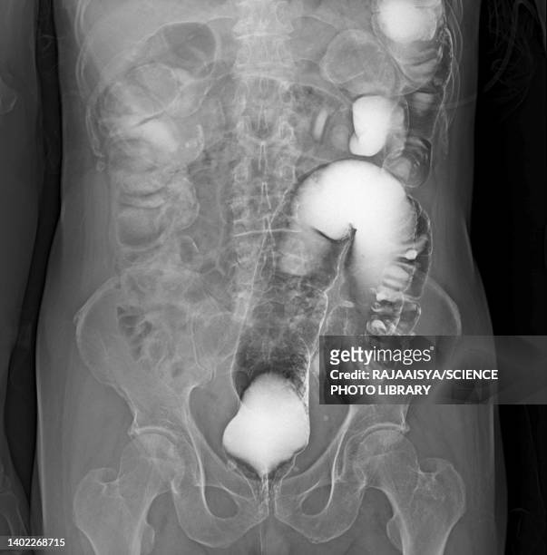 colon diverticula, x-ray - bas stock pictures, royalty-free photos & images
