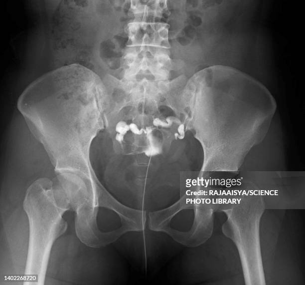 obstructed fallopian tube, x-ray - äggledare bildbanksfoton och bilder