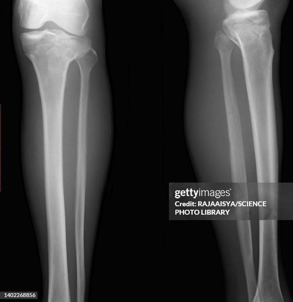 tibial plateau fracture, x-ray - comminuted fracture stock pictures, royalty-free photos & images